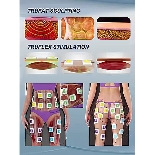 Delux TrueRF profesionalni RF i EMS uređaj za oblikovanje tijela